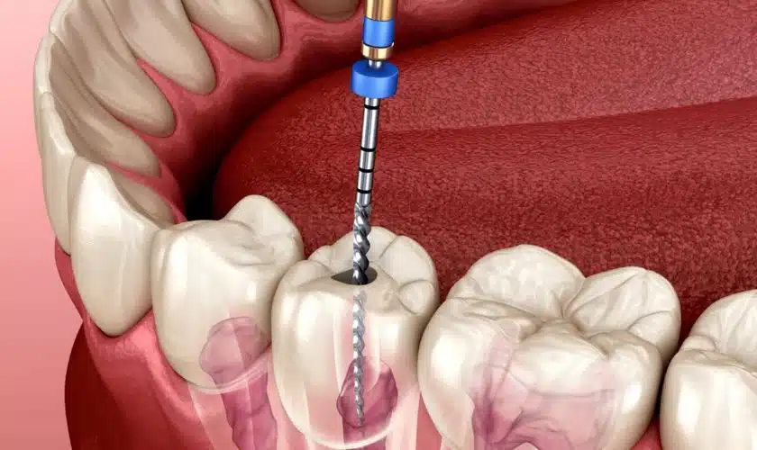 root canal treatment in the UK.