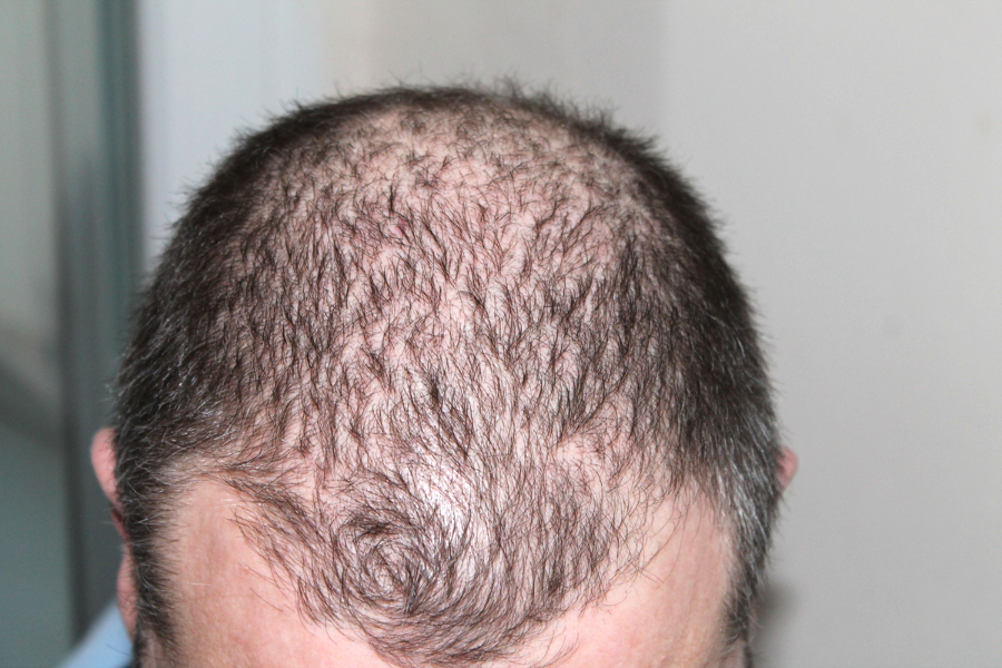 Key things to check before finding a clinic for alopecia in Laval (alopecie Laval)