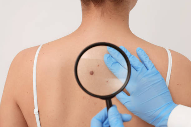 Laser birthmark removal in Abu Dhabi