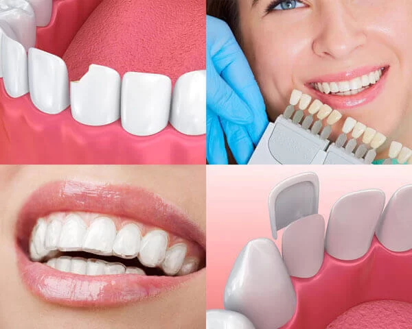 Restoring Smiles with Dental Implants in Tampa: A Comprehensive Guide