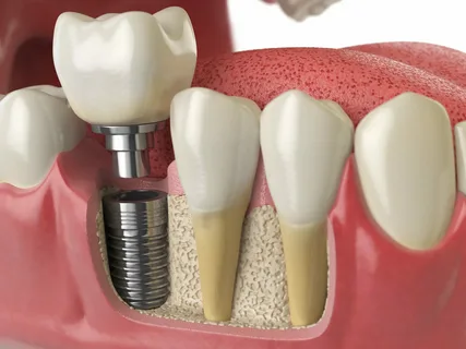 Dental Implants Leichhardt