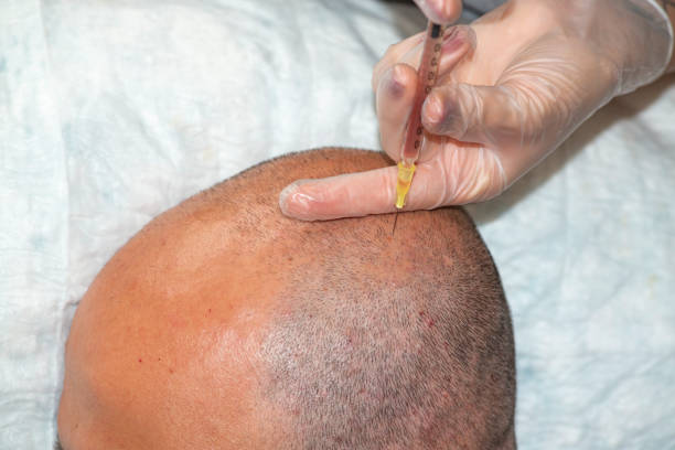 Hair Transplant Cost in Abu Dhabi: Where Quality Meets Value