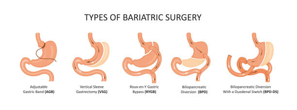 Revolutionize Your Wellness: Bariatric Surgery in Abu Dhabi