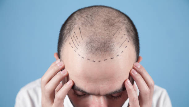 Reclaim Your Youth: FUE Hair Transplant in Abu Dhabi