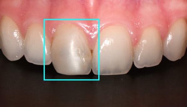 How Does the Dental Crown Procedure Enhance Your Smile?