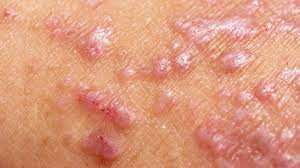 Spongiotic Dermatitis vs Eczema