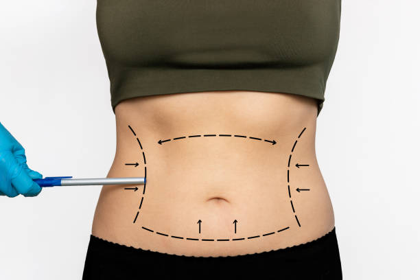 Discover Sculpted Perfection: Vaser 4D Liposuction in Abu Dhabi