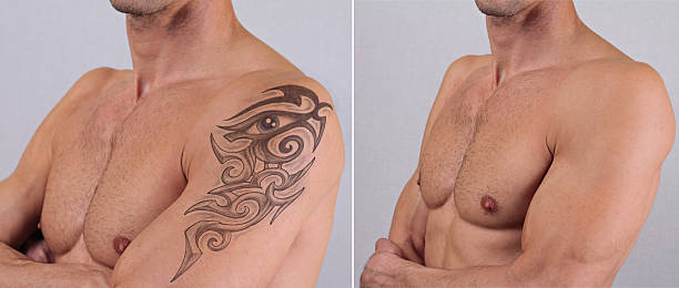 Laser Tattoo Removal in Abu Dhabi