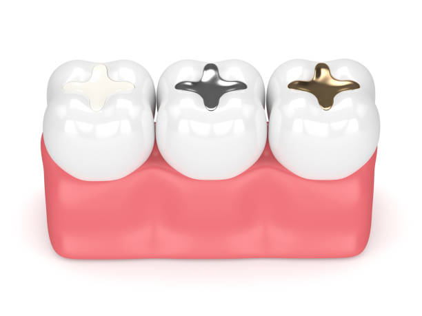 Choosing Composite Fillings for a Seamless Smile