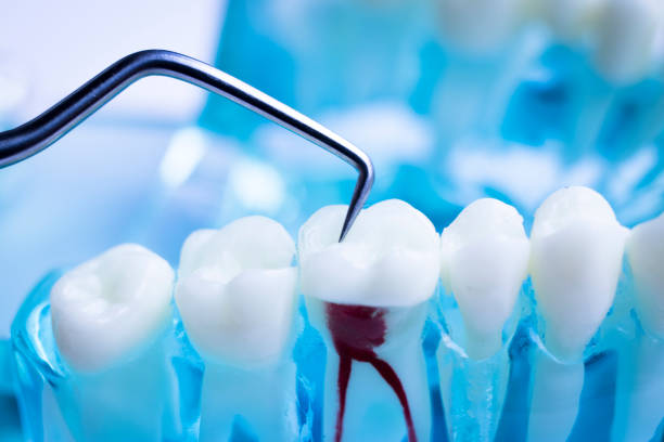 Root Canal Treatment in Abu Dhabi