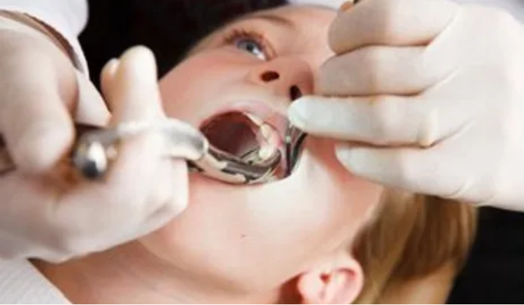 SmileWorks: Your Trusted Choice for Dental Fillings and Veneers in New York City