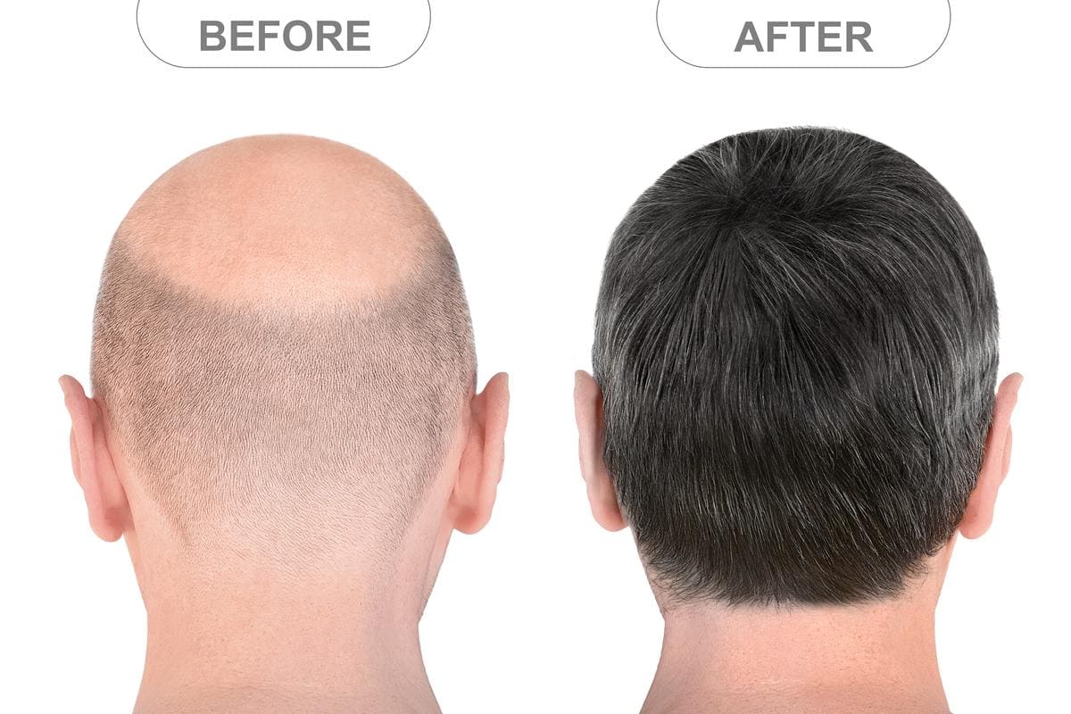 Why is my scalp red after a hair transplant? What should I do with this?